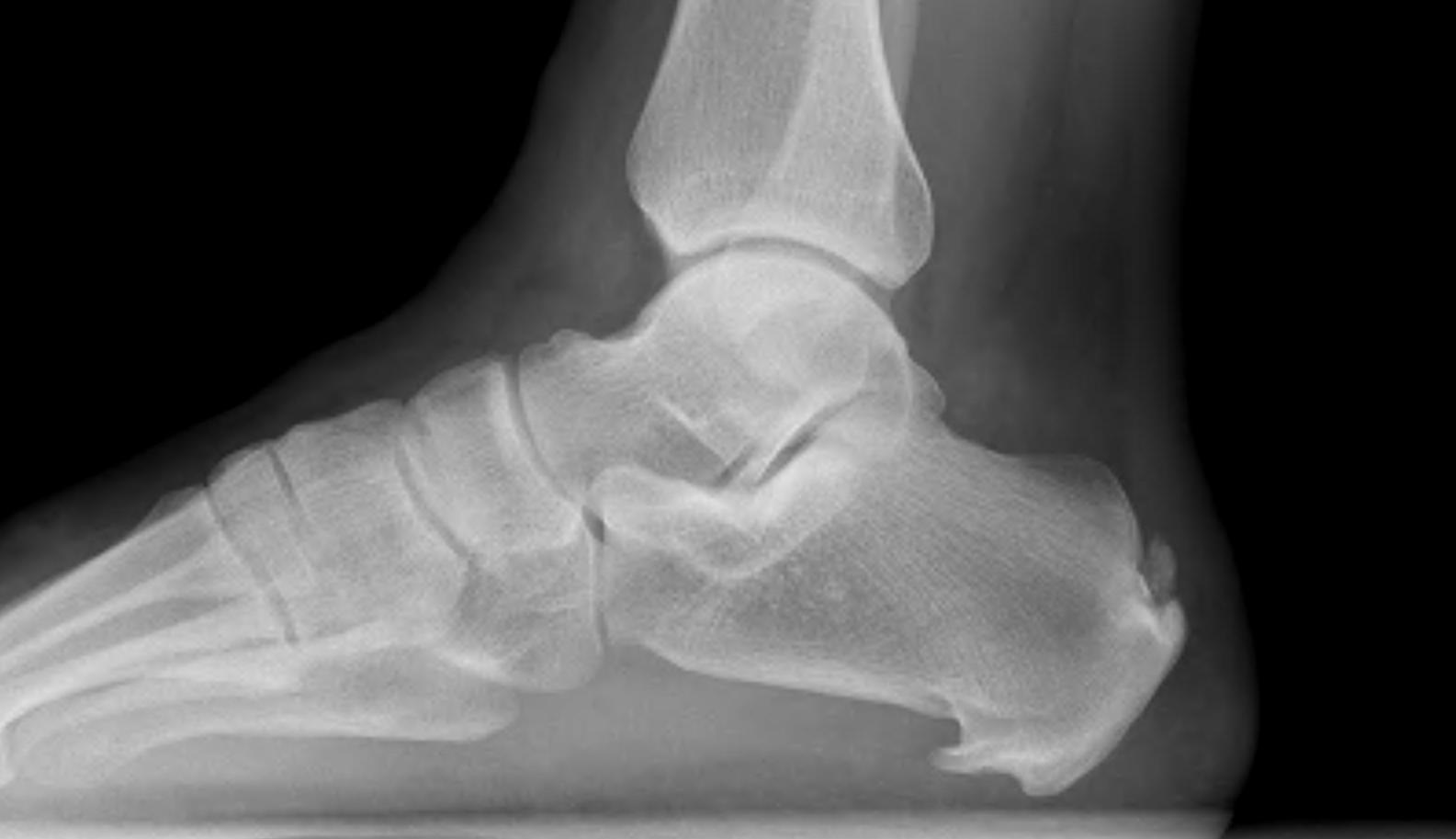 Foot Calcaneal Spur